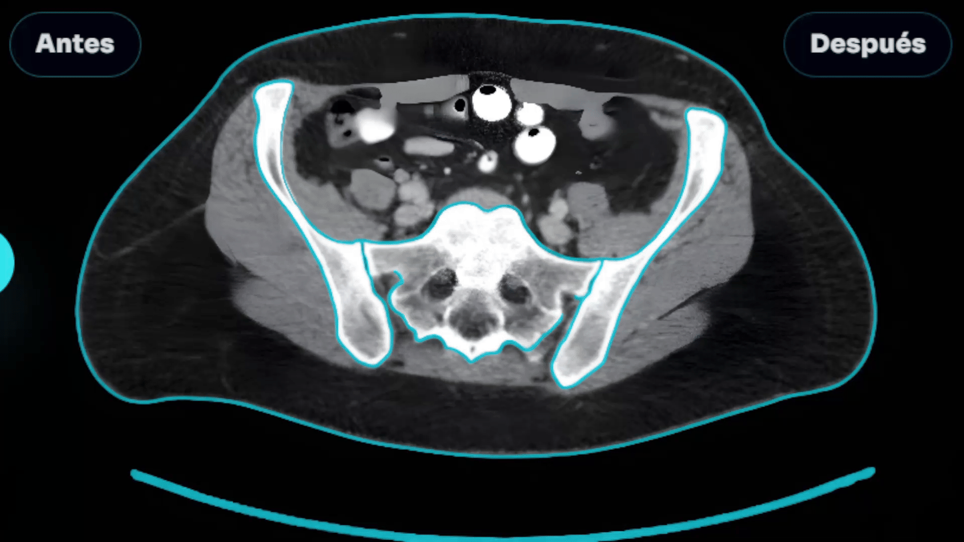 Animación del proceso de segmentación ósea